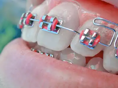 How Much Are The Cheapest Braces In South Africa